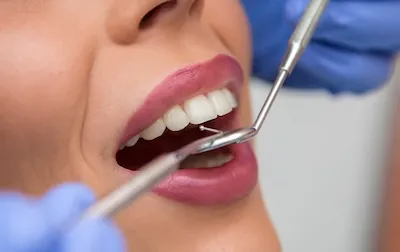 Limpieza dental profesional
